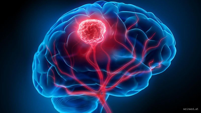 Hirntumor im Blutbild sehen? Die Wahrheit, die dich überraschen wird!