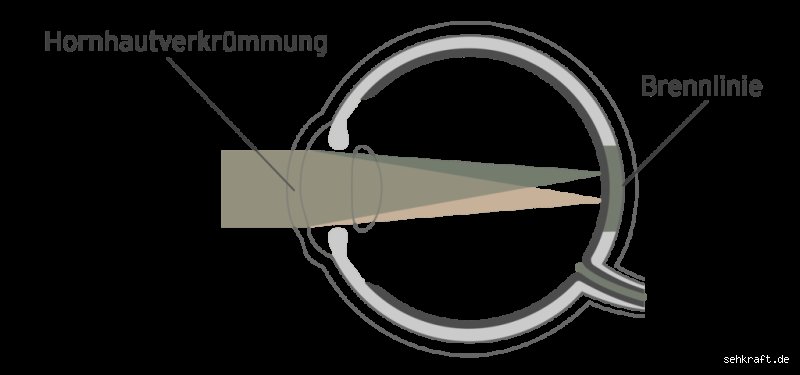 Kann man Hornhautverkrümmung wirklich spüren? Eine ehrliche Einschätzung