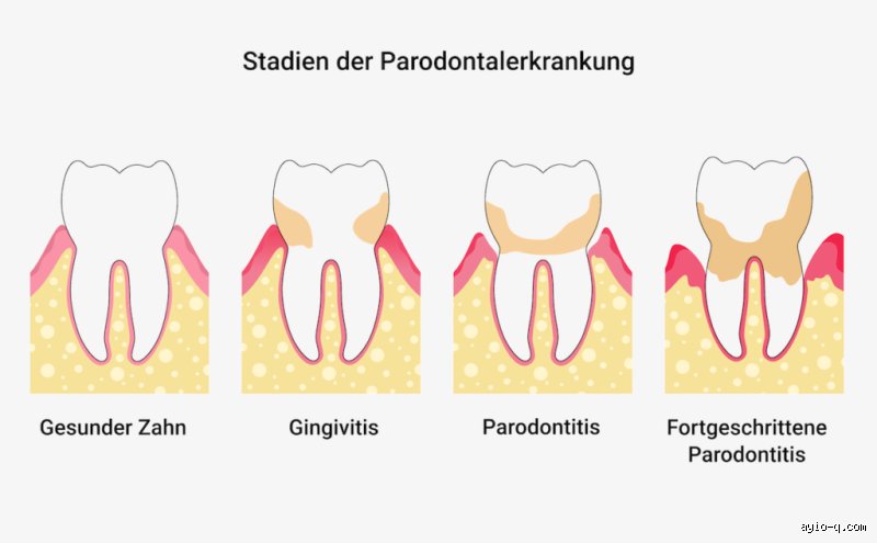 Kann Parodontose wieder weg gehen?