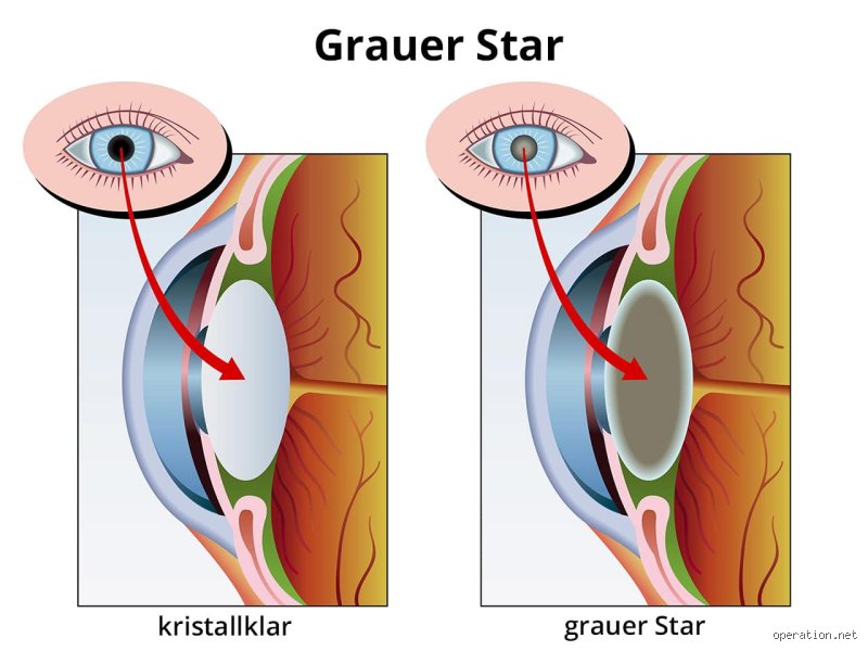 Schone Wann Wieder Autofahren Nach Grauer Star Op Ebenbild