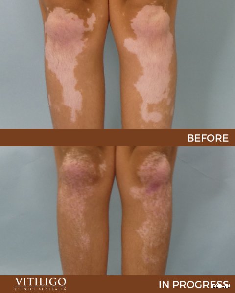 Kann Vitiligo sich zurückbilden?