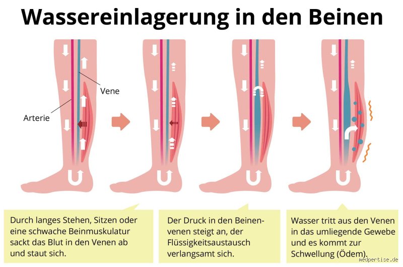 Kann Wasser in den Beinen vom Herzen kommen?