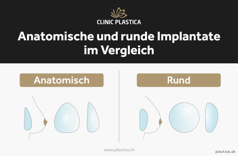 Können Runde Implantate natürlich aussehen?