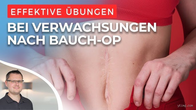 Können Verwachsungen im Bauch weh tun? Ursachen, Symptome und Behandlungswege
