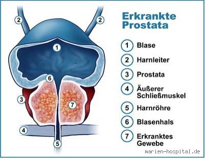 Sind Eier schlecht für die Prostata? Wissenschaftliche Fakten und Ernährungsempfehlungen
