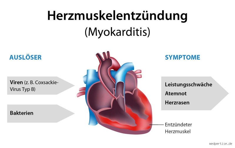 Wann droht Herzmuskelentzündung?