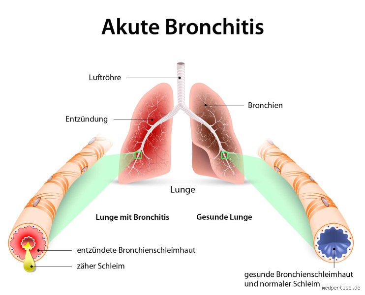 Wann ist eine Bronchitis bakteriell?