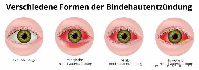 Wann sollte man mit einer Bindehautentzündung zum Arzt?