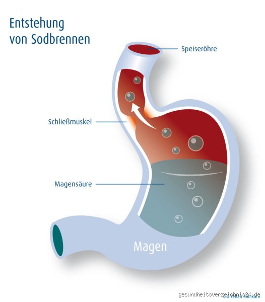 Wann sollte man mit Sodbrennen zum Arzt?