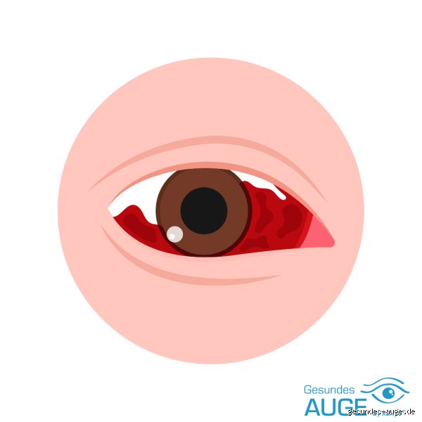 Warum jeder Tropfen Blut im Auge ein Notfall sein kann – Meine Gedanken zur Augenblutung