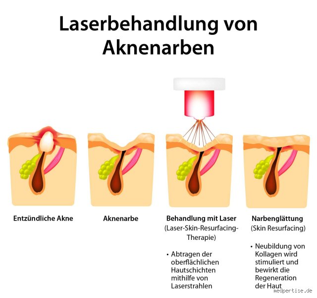 Warum juckt die Haut nach Laserbehandlung? Ursachen und professionelle Lösungen