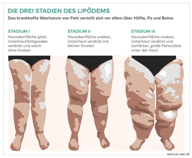Warum kein Alkohol bei Lipödem?