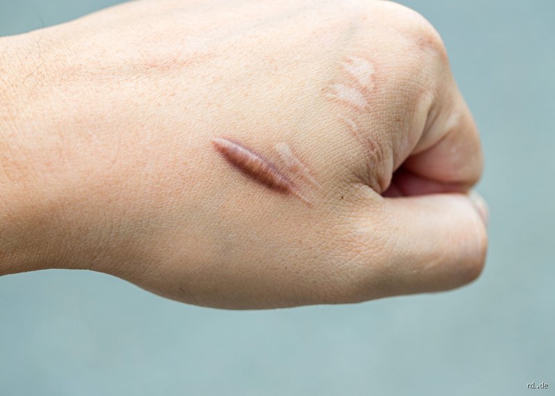 Warum tut meine Narbe weh? Ursachen, Physiologie und effektive Lösungen