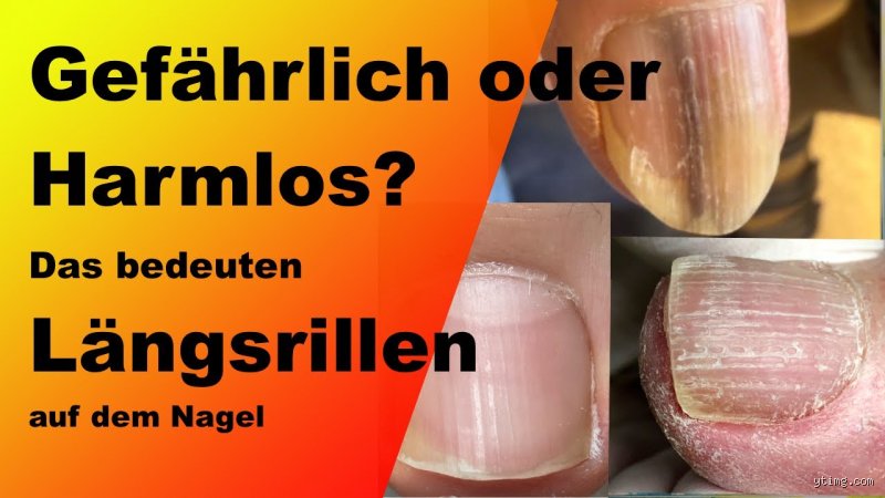 Was bedeuten Längsrillen in den Zehennägeln?