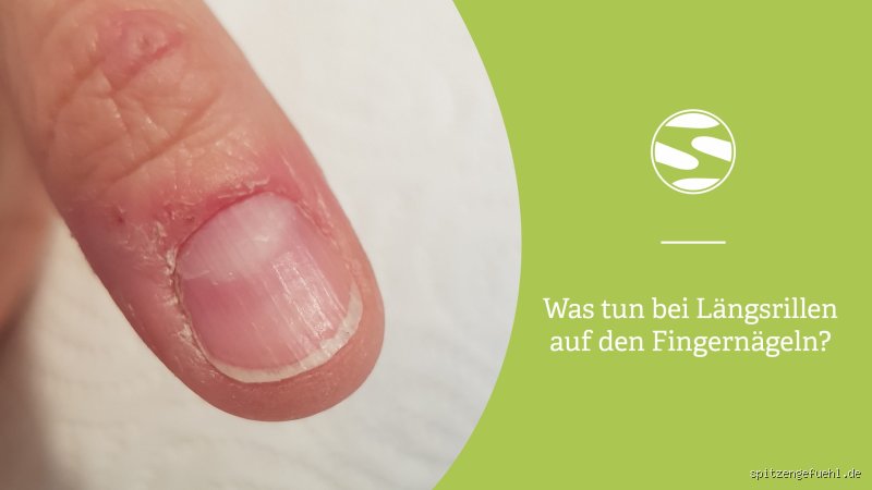 Alarmierende Rillen auf deinen Nägeln? Was sie wirklich bedeuten!