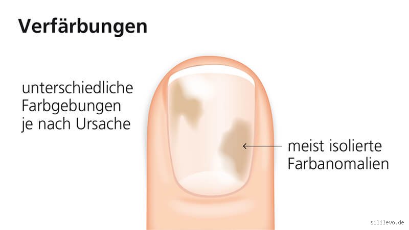 Was bedeutet verfärbte Nägel?