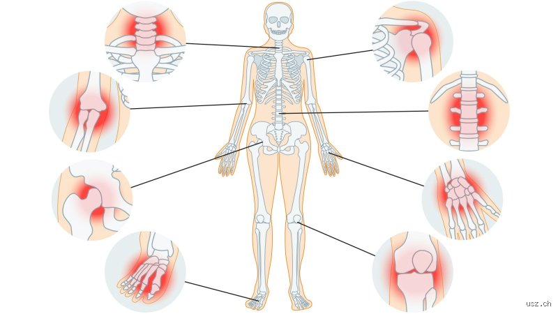 Was fehlt dem Körper bei Arthrose? Chronische Gelenkschmerzen und der unterschätzte Nährstoffmangel