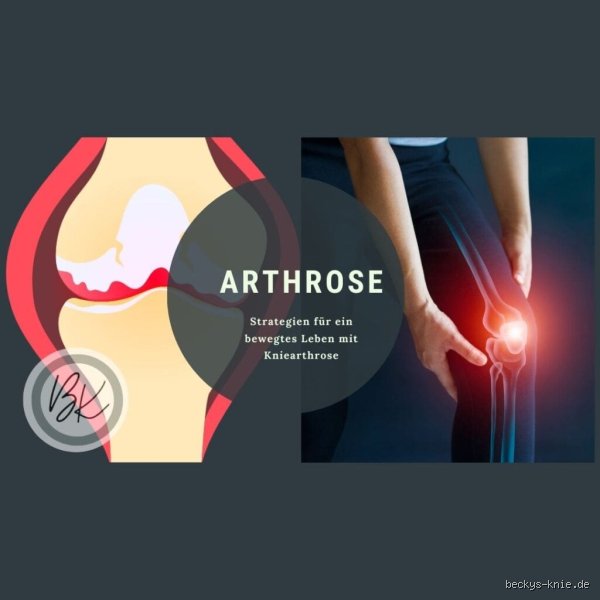 Was hilft am besten gegen Arthrose im Knie?