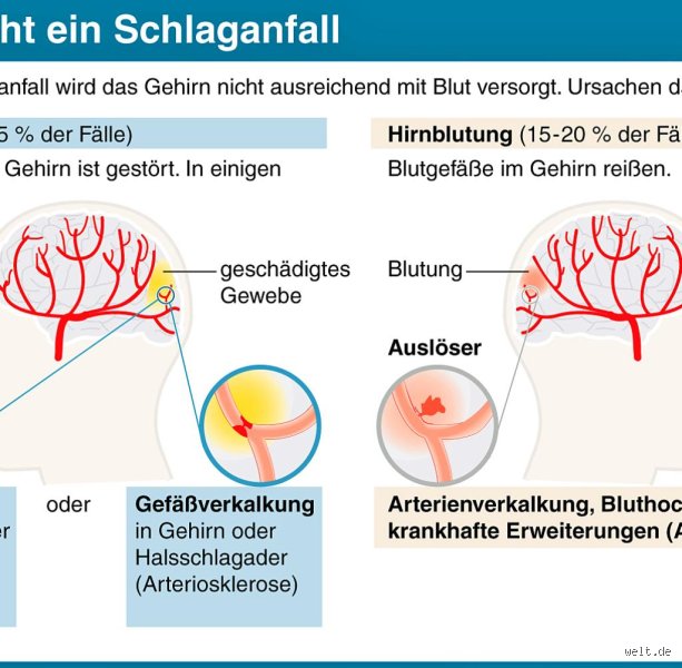 Was ist schlimmer Schlaganfall oder Hirnschlag?