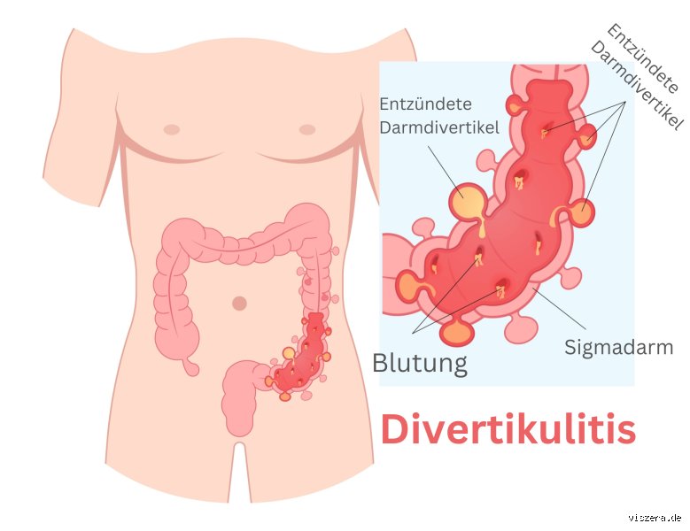 Was ist verboten bei Divertikulitis?