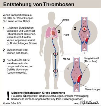 Was kann Blutgerinnsel auflösen: Die faszinierende Medizin hinter dem Gerinnungsmanagement und körpereigenen Mechanismen