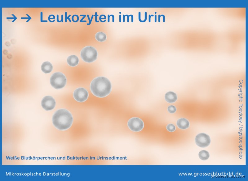 Was kann Leukozyten im Urin verfälschen?