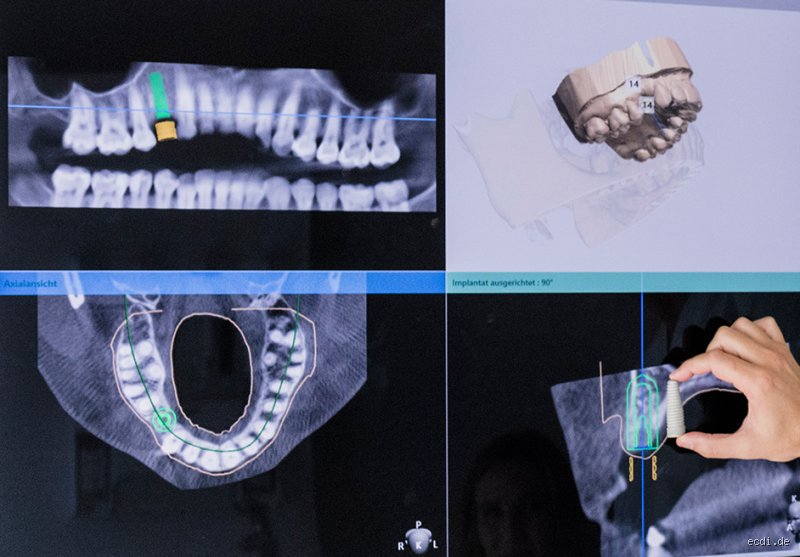 Kosten für 8 Implantate mit Knochenaufbau: Transparente Einblicke und praktische Tipps