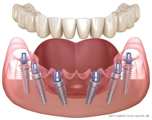 Was kostet ein komplettes Gebiss mit Implantaten in Polen?