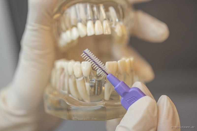 Was kostet eine Implantat Reinigung wirklich? Meine ehrliche Einschätzung