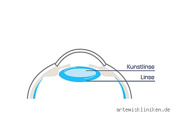 Was kostet eine neue Linse fürs Auge?