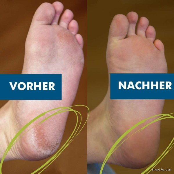 Was löst Hornhaut auf: Chemische Methoden, Wirkstoffe und wissenschaftliche Fakten im Praxis-Check