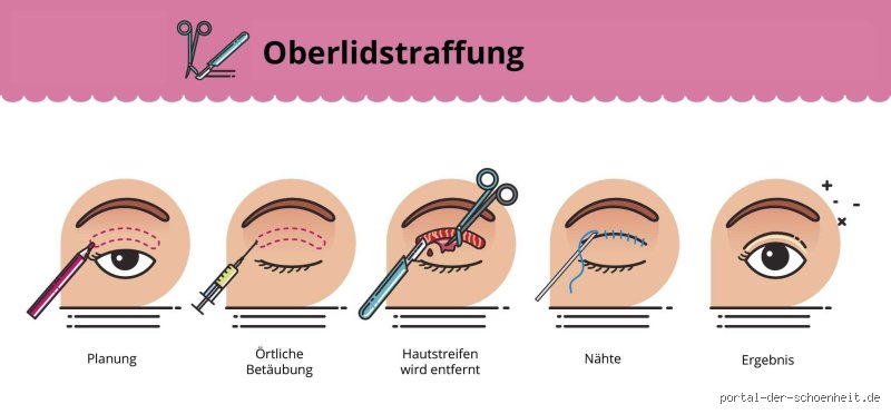 Was passiert bei einer Oberlidstraffung? Ein detaillierter Blick auf den Ablauf und mehr