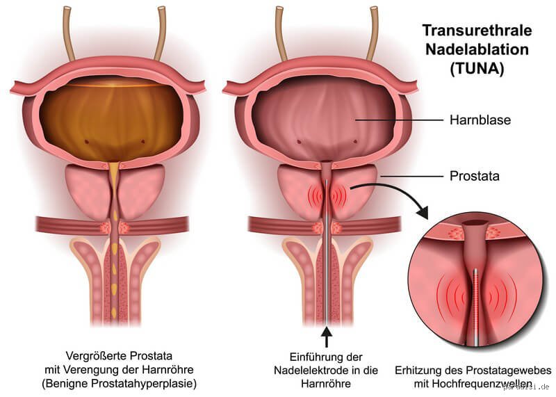 Was passiert mit Samen nach Prostata-OP? Alles Wissenswerte aus Erfahrung und Fakten