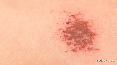 Was passiert unter Schorf? Die verborgene Welt der Wundheilung