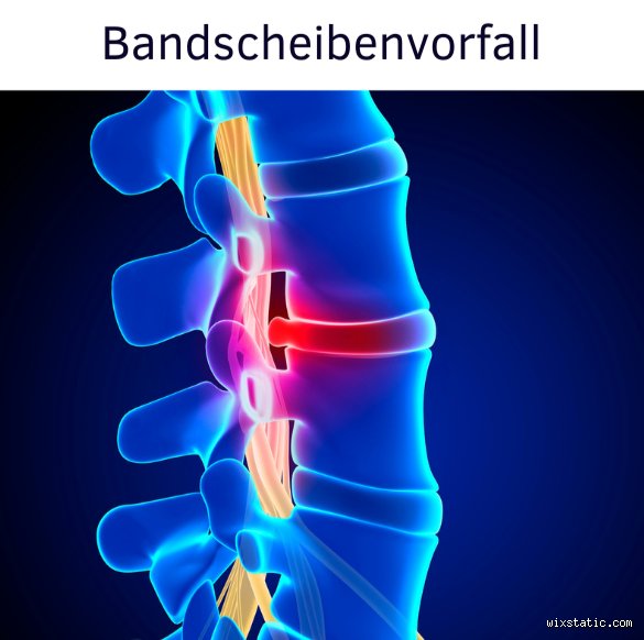 Was passiert, wenn man einen Bandscheibenvorfall ignoriert?