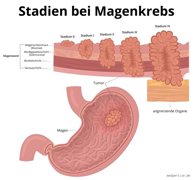 Was passiert wenn man Magenkrebs hat?