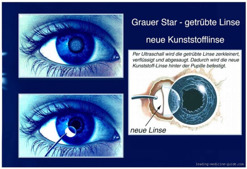 Was passiert, wenn man sich den Grauen Star nicht operieren lässt?