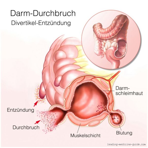 Was passiert, wenn sich der Darm nicht vollständig entleert? Die frustrierende Realität der Restentleerung