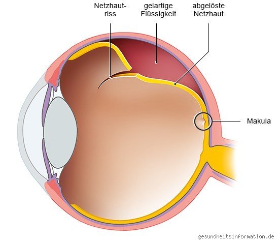 Was passiert, wenn sich die Netzhaut vom Auge löst?