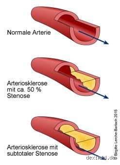 Was reduziert Arteriosklerose?