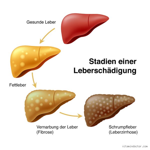 Was sind die Symptome einer Fettleber Grad 1?