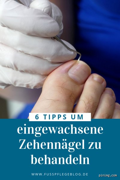 Was tun bei abstehendem Zehennagel?