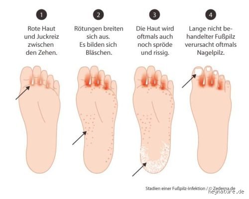 Was tun bei Verdacht auf Fußpilz?