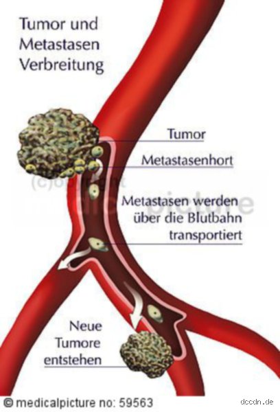 Was vernichtet Metastasen?