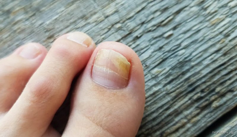 Was vernichtet Nagelpilz?