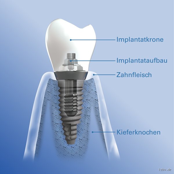 Was wiegen Implantate? Praktische Einblicke und Fakten