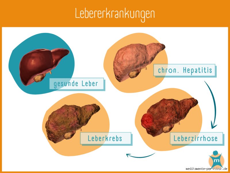 Welche Farbe hat die Zunge bei Leberzirrhose?