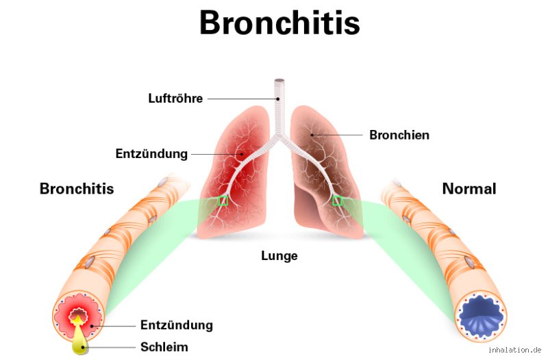 Welche Farbe Schleim bei Bronchitis?