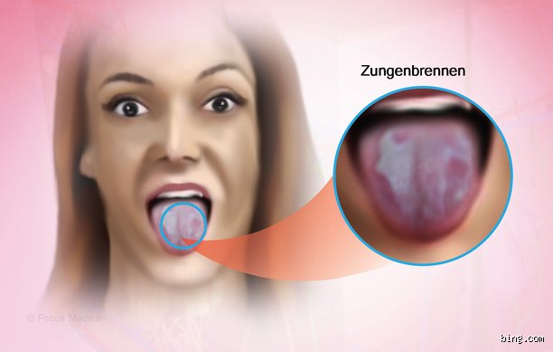 Welche Krankheiten stecken hinter Zungenbrennen? Alles, was ich darüber gelernt habe