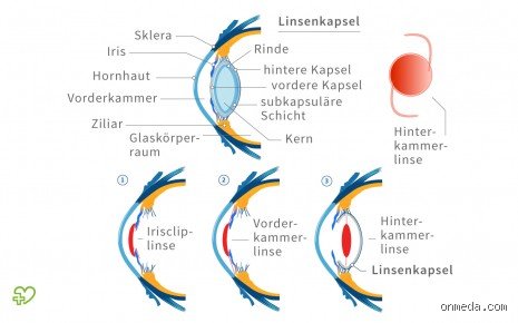 Welche Linsen sind bei Grauem Star am besten?
